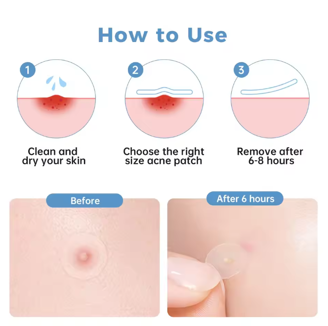 Porecura Acne Plasters