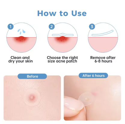 Porecura Acne Plasters
